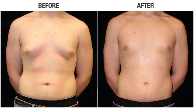Gynecomastia-Surgery