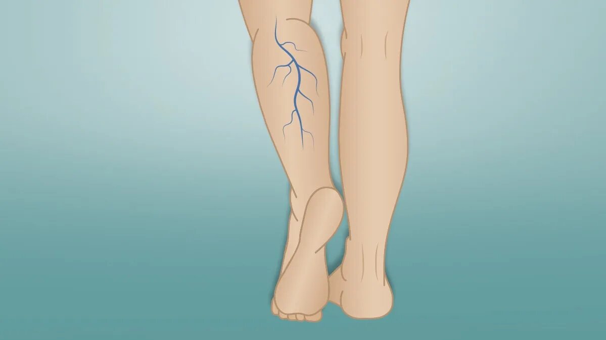 What is the Best Treatment to Remove Large Varicose Veins?