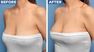 Top 5 Benefits of a Breast Lift Surgery