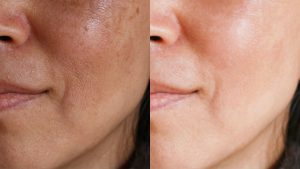 Uneven Skin Tone And Get Clear Skin Treatment