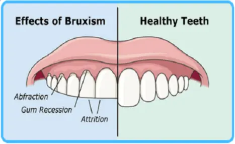 Clenching Teeth